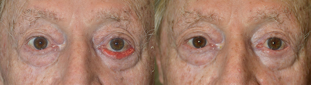 80+ year old man, with chronic left lower eyelid cicatricial ectropion (eyelid rolls out; droopy lower eyelid) with significant eye redness and irritation and discharge, underwent lower eyelid ectropion surgery with skin graft, under local anesthesia. Before and 3 months postoperative photos are shown.