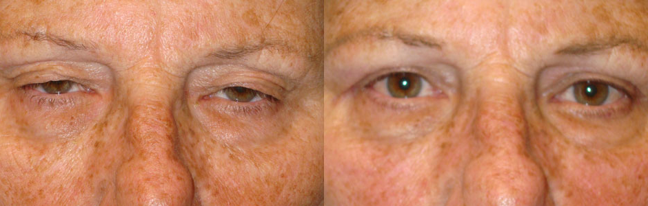 Middle age woman, with significant upper eyelid ptosis (droopy upper eyelids), interfering with her vision, along with excess upper eyelid skin, underwent upper eyelid ptosis surgery (eyelid lift) and upper blepharoplasty (removed excess skin), under local anesthesia. Before and 3 months postoperative photos are shown.