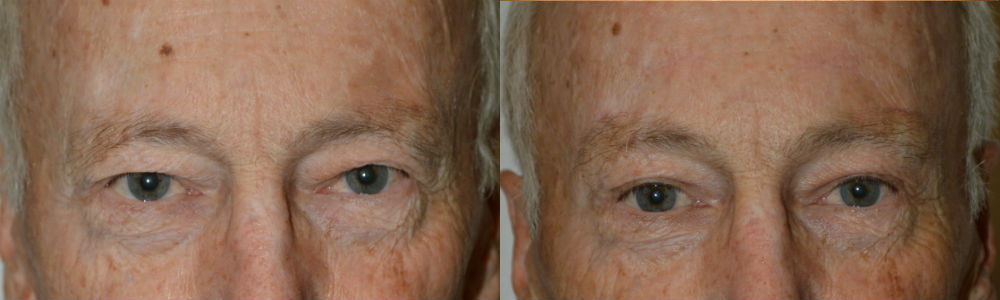 Eyelid Surgery and Browlifting