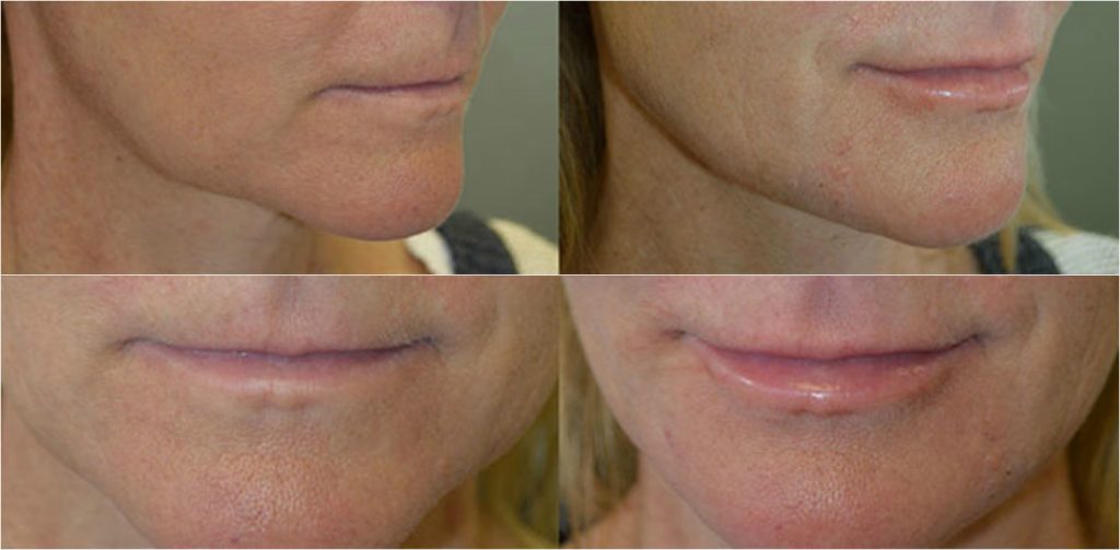 beverly-hills-liquid-facelift