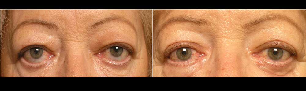 60 year old female, with lower eyelid retraction (droopy lower eyelids) and scleral show, underwent lower eyelid retraction surgery using internal dermis/fat graft. Note improved lower eyelid position.