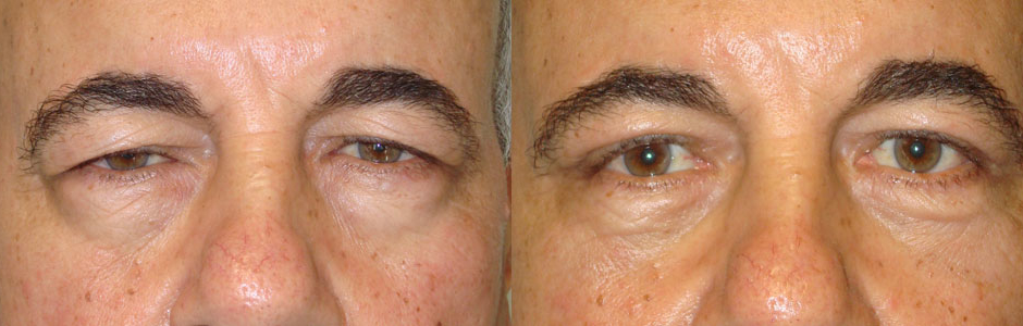 55 year old man, with heavy droopy upper eyelids and tired eye look, underwent upper eyelid ptosis repair (internal approach, to raise droopy upper eyelids) and male upper blepharoplasty (conservative upper eyelid skin removal), under local anesthesia. Note the eyes are more open, with natural appearance in the 3 months photo after eyelid surgery.