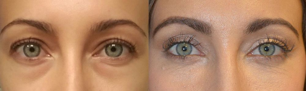 29-year-old female, with under eye bags (fat prolapse) and dark circles (tear trough deformity hollowness), underwent transconjunctival lower blepharoplasty (scar-less, no stitch incision inside lower eyelid) with fat repositioning to get of the bags and fill in the hollow under area at the same time. The procedure was done under local anesthesia with oral sedation (xanax) in the office. You can find her story and surgical video on this page.