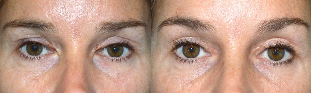 This patient suffered from severe eyelid scarring in the medial canthus from previous blepharoplasty with canthal web. She underwent revision eyelid scar surgery with epicanthoplasty. Preoperative and 3 months postoperative photos are shown.