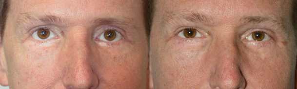 Middle age man, with lower eyelid retraction after previous aggressive lower blepharoplasty, with rounded eyes and sclera show, underwent reconstructive revision eyelid plastic surgery: lower eyelid retraction surgery (with internal graft and midface lift) and canthoplasty, to create more natural almond eye shape. Preop and 4 months postoperative photos are shown.