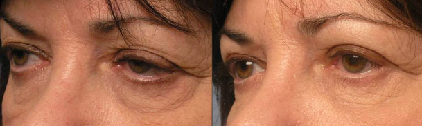 Middle age woman, with eyelid aging, droopy upper eyelids (ptosis), under eye bags/wrinkles, and droopy lower eyelids, underwent cosmetic lateral canthoplasty (plastic surgery on outer corner of the eye), upper and lower blepharoplasty (to remove excess skin and fat) and eyelid ptosis repair (to lift upper eyelids), resulting in more youthful, natural almond shape eyes. Preop and 3 months postoperative photos after cosmetic eyelid surgery are shown.