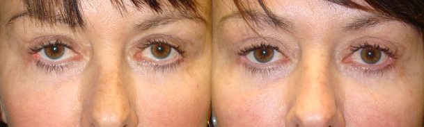 Middle age woman, with rounded sad eyes and lower eyelid retraction with inability to fully close her eyes secondary to lower eyelid retraction (postblepharoplasty eyelid and canthus scarring), underwent revision eye plastic surgery to raise the lower eyelids (eyelid retraction repair) and closed canthoplasty to provide better eyelid function and shape. Before and 3 months after eyelid surgery photos are shown.