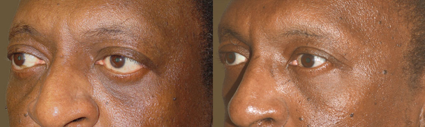 Middle age man, with history of Graves thyroid eye disease, underwent orbital decompression surgery (to correct bulging eyes) followed later by lower eyelid retraction repair (internal approach, without graft) and canthoplasty to give more almond shape eyes.