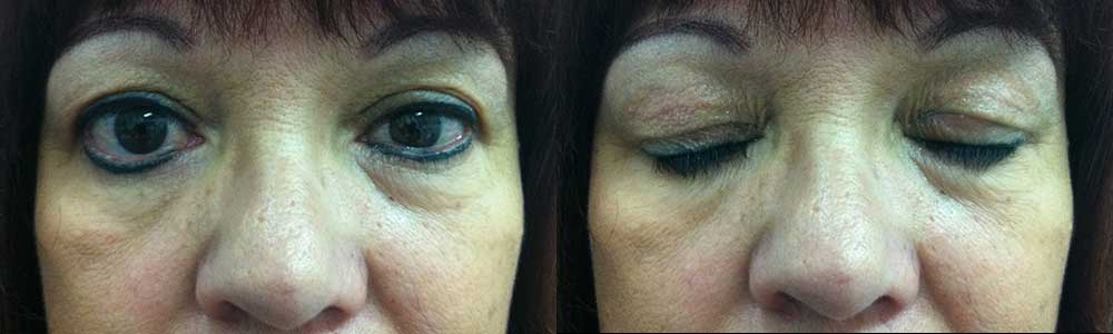 58 year old female, with left facial palsy with paralytic lagophthalmos, with left upper eyelid gold, with eyes open and closed, showing the gold weight is not visible but it is doing its job to make the left eye close better.