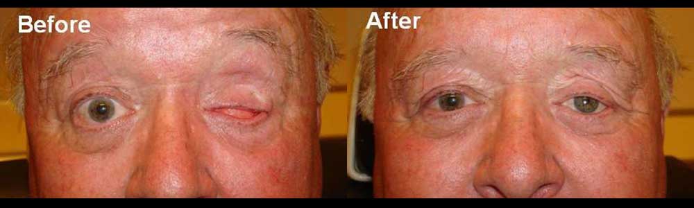 Before (left) and after (right) prosthetic eye (after eye removal)