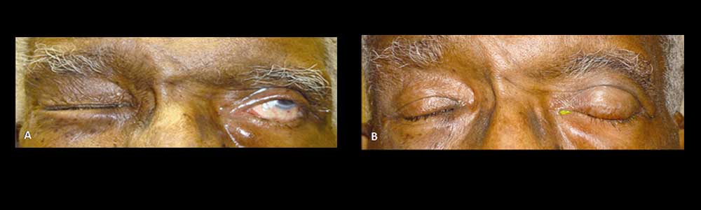 70+ year old male, with left facial palsy, with inability to close the left eye (lagophthalmos) as shown in the left photo. He received left upper eyelid hyaluronic acid gel filler injection, as non-surgical treatment, to help close the left eye, as shown in the after photo (right).