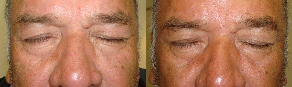 60 year old male, with right eyelid paralytic lagophthalmos (eye not fully closing), underwent right upper eyelid gold weight placement under local anesthesia. The gold weight made the right upper eyelid heavier, which helps it close better. Note resolution of the lagophthalmos in the 3 months postoperative photo (right photo). The gold weight is hidden in the right upper eyelid.