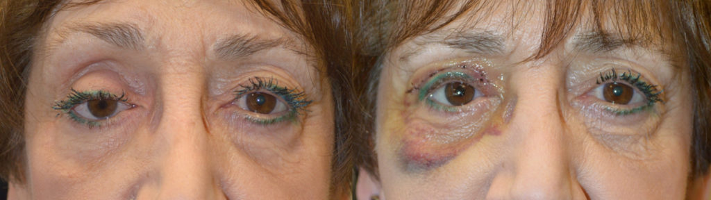 75 year old female, with history of right eye removal with poor eye prosthesis fit and appearance, underwent initial right socket silicone implant placement followed later by right upper eyelid ptosis repair. Before and 1 week after eyelid ptosis repair photos are shown.