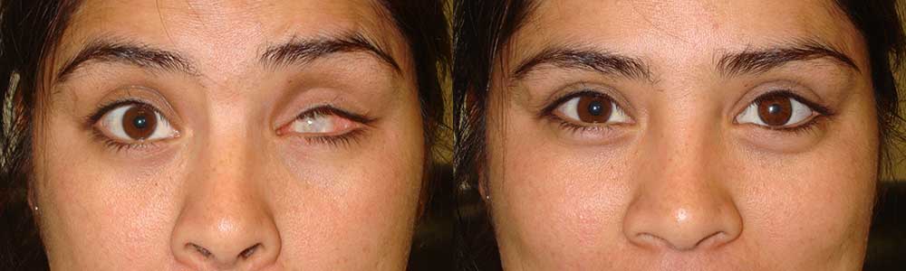 Before (left) and after (right) prosthetic eye (after enucleation/eye removal)