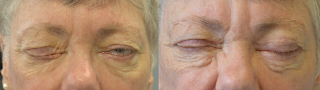 68 year old female, with paralytic left lagophthalmos (unable to close left eye) from left eyelid facial palsy, underwent left upper eyelid gold weight and left lower eyelid ectropion repair with skin graft. Before and 3 months after eyelid surgery photos are shown.