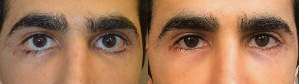 27 year old male, with history of multiple lower eyelid operations with severe lower eyelid retraction, sclera show and eyelid scarring, underwent revision lower eyelid retraction surgery (internal lift, soof lift, alloderm spacer graft, canthoplasty, scar revision). Before and 2 months after revision eyelid surgery photos are shown. (The after photo is a selfie.)