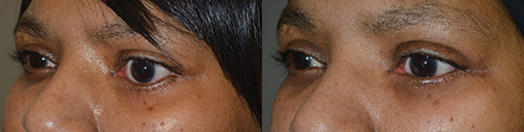 Middle age woman with left facial palsy with left lower eyelid retraction underwent left lower eyelid retraction surgery and canthoplasty, without eyelid spacer graft. Before and 3 months postoperative photos are shown.
