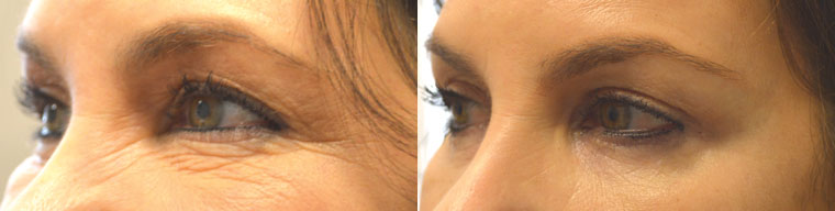 55 year old female, complained of saggy eyelids with loose skin. She underwent cosmetic eyelid surgery including upper blepharoplasty, lower blepharoplasty, and lateral brow lift, under local anesthesia in the office. Before and 2 months postoperative photos are shown, with more youthful, yet natural, results.