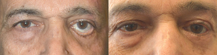 Middle age man with severe left lower eyelid retraction after previous lower eyelid surgery with inability to close the left eye, underwent revision left lower eyelid surgery (lower eyelid retraction surgery with internal alloderm spacer graft and external skin graft). Before and 3 months postoperative photos are shown.