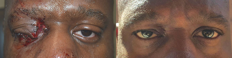 Young man, with severe right upper eyelid and canalicular (tear duct) laceration from motor vehicle accident, underwent eyelid laceration repair. Before and 3 months postoperative photos are shown.