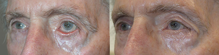 70+ year old male, with left facial/eyelid paralysis from Bells palsy with paralytic left lower eyelid ectropion, underwent left lower eyelid ectropion surgery with skin graft. Before and 3 months postoperative photos are shown.