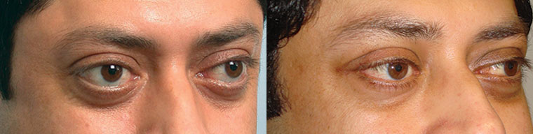 Middle age Indian male, with inherited bulgy eyes, underwent bilateral cosmetic orbital decompression surgery. Before and 3 months postoperative photos are shown.