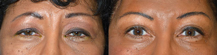 Middle age African-American female, complained of droopy saggy upper eyelids with tired eye appearance. She underwent bilateral upper eyelid ptosis repair (droopy eyelid surgery via muscle tightening), upper blepharoplasty (skin removal), and lateral pretrichial brow lift, to give more youthful natural eye appearance. Before and 3 months after cosmetic eyelid surgery postoperative photos are shown.