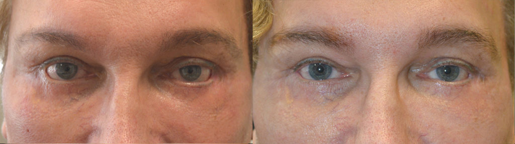 65 year old male, with history of multiple lower eyelid surgeries and canthoplasties with persistent lower eyelid retraction, with trouble closing his eyes, underwent revision lower eyelid retraction repair. Before and 3 months after revision eyelid surgery photos are shown. Patient is very happy with the improvement achieved.