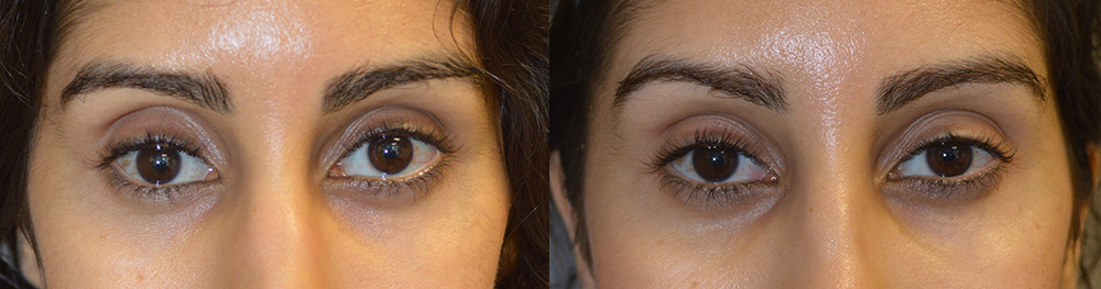 27-year-old female, has severe right sunken eye (enophthalmos) from silent sinus syndrome. CT scan shows severe shrinkage of the right maxillary sinus with displacement of the eyeball downward (hypoglobus). She underwent right orbital implant placement (along with sinus surgery) to restore the right eyeball position. Before and 1 month after surgery photos are shown. You can listen to her testimonial on our testimonial page