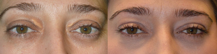 38-year-old female, underwent cosmetic eyelid procedure under local anesthesia to remove upper eyelid xanthelasma (cholestrol deposit under eyelid skin). Before and 1 month after procedure photos are shown.