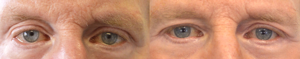 77 year old male, with post-blepharoplasty lower eyelid retraction (after transcutaneous lower blepharoplasty done by another surgeon), underwent corrective lower eyelid retraction surgery using scar-less conjunctiva approach with SOOF (midface) lift without spacer graft. Before and 3 months after revision eyelid surgery photos are shown.