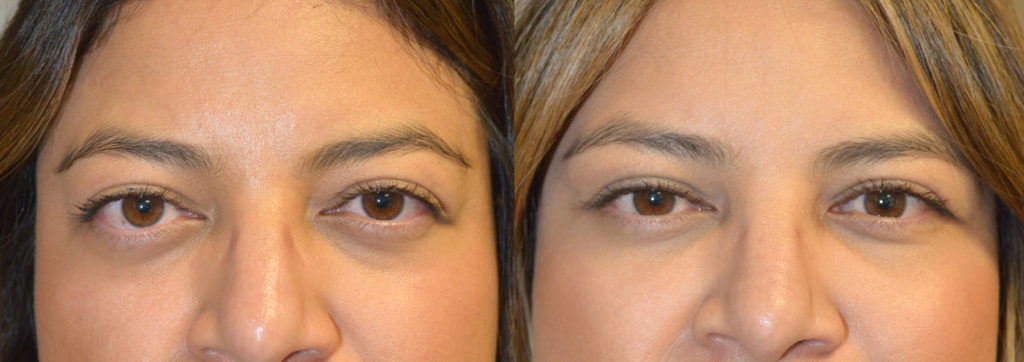 34 year old female, with bulging eyes from Graves disease, underwent combined orbital decompression surgery plus lower eyelid retraction surgery plus orbital rim (tear trough) implant placement. Before and 6 weeks after surgery results are shown. You can see her video testimonial on our website testimonial page and her surgical video on specified procedures.