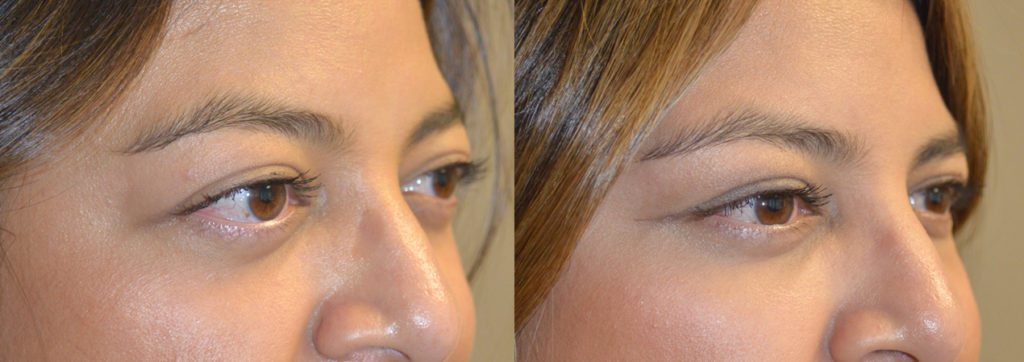 34 year old female, with bulging eyes from Graves disease, underwent combined orbital decompression surgery plus lower eyelid retraction surgery plus orbital rim (tear trough) implant placement. Before and 6 weeks after surgery results are shown. You can see her video testimonial on our website testimonial page and her surgical video on specified procedures.