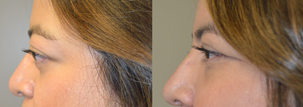 34 year old female, with bulging eyes from Graves disease, underwent combined orbital decompression surgery plus lower eyelid retraction surgery plus orbital rim (tear trough) implant placement. Before and 6 weeks after surgery results are shown. You can see her video testimonial on our website testimonial page and her surgical video on specified procedures.