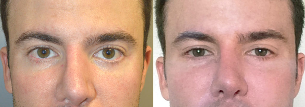 38 year old male, with lower eyelid retraction due to previous lower blepharoplasty (by another surgeon), underwent lower eyelid retraction surgery (with alloderm spacer graft), canthoplasty, and tear trough (orbital rim) implant placement. Before and 6 months after surgery results are shown. You can see his written testimonial on realself https://www.realself.com/review/beverly-hills-ca-eyelid-retraction-repair-eyelid-retraction-surgery