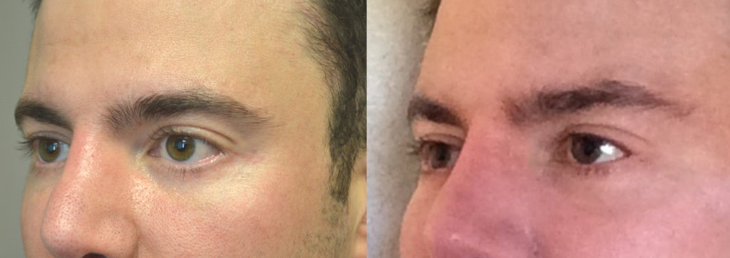 38 year old male, with lower eyelid retraction due to previous lower blepharoplasty (by another surgeon), underwent lower eyelid retraction surgery (with alloderm spacer graft), canthoplasty, and tear trough (orbital rim) implant placement. Before and 6 months after surgery results are shown. You can see his written testimonial on realself https://www.realself.com/review/beverly-hills-ca-eyelid-retraction-repair-eyelid-retraction-surgery