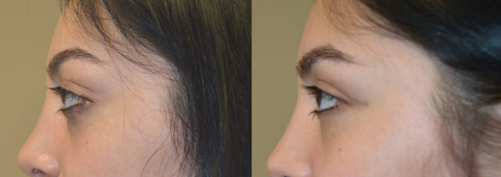 18 year old female teenager, with rare childhood Graves disease resulting in bulging eyes and change in eye shape, underwent orbital decompression surgery and lower eyelid retraction surgery. Before and 2 months after surgery results are shown. You can find her video testimonial on our website testimonial page.