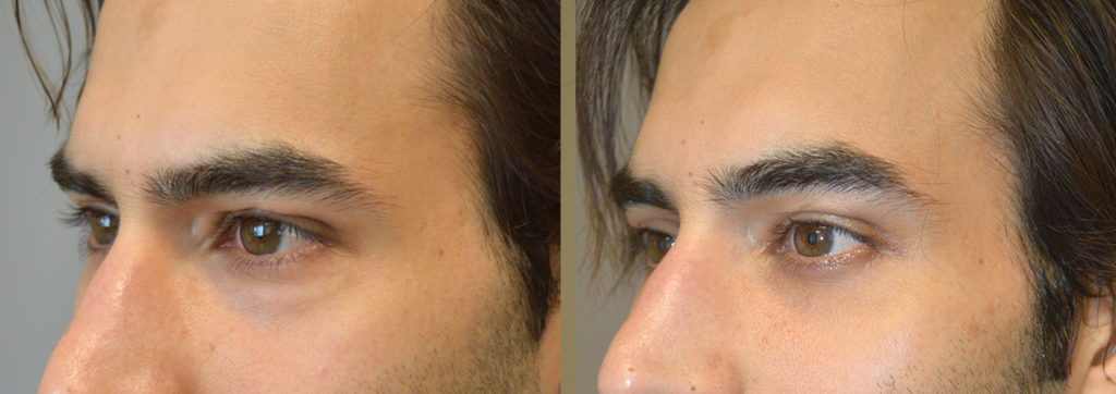 27 year old male actor, complained of looking tired on camera due to under eye bags and dark circles (hollowness). He underwent cosmetic lower blepharoplasty (transconjunctival with fat bags repositioning). Before and 2 months after cosmetic eyelid surgery photos are shown.