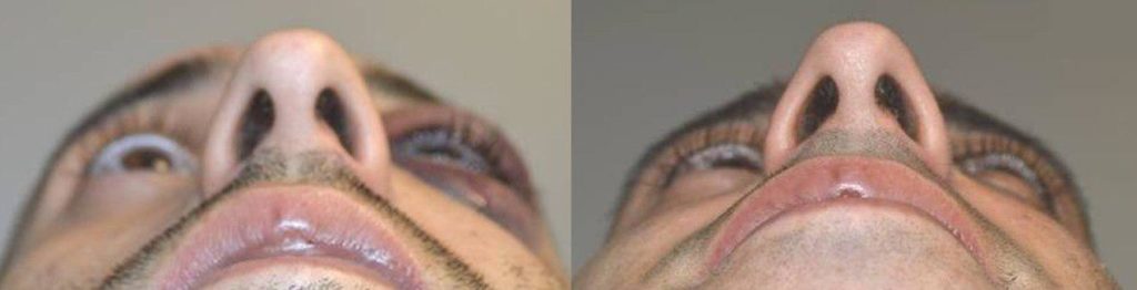 Young male suffered left zygomatic arch and orbital blowout fracture (tripod fracture) from blunt trauma. He underwent tripod fracture repair and orbital floor fracture repair. Before and 1 month after surgery photos are shown.