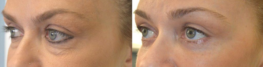 43 year old female, complained of under eye bags and wrinkles and dark circles. She underwent transconjunctival lower blepharoplasty (incision inside the lower eyelid) with fat bags repositioning to fill the hollow area below the bags, plus skin pinch technique to remove loose skin. Before and 6 weeks after cosmetic lower eyelid surgery photos are shown.
