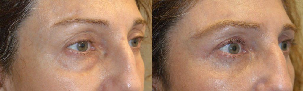 56 year old female, complained of looking tired and older. She underwent transconjunctival lower blepharoplasty with fat/bags repositioning (to fill hollow tear trough area, dark circles) and skin pinch removal. Note more rested eye appearance without change in eye shape with natural results. She also had concurrent skin only upper blepharoplasty. Before and 6 weeks after cosmetic quad-blepharoplasty photos are shown. (In future, she would benefit from upper eyelid filler injection to improve pre-existing hollow, sunken upper eye area.)