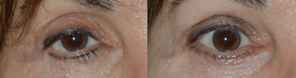 Beverly Hills Fat Graft Injectable Eye Treatment