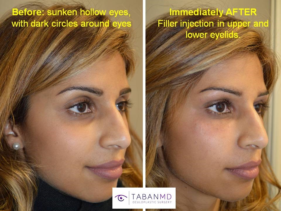 Los Angeles Oculoplastic Nonsurgical Solutions