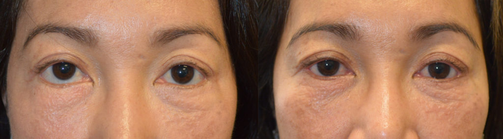 46 year old Asian female, with lower eyelid retraction after previous transcutaneous lower blepharoplasty, underwent revision eyelid surgery to raise the lower eyelids (lower eyelid retraction surgery) using internal eyelid approach with soof lift and internal alloderm graft and canthoplasty. Before and 5 months after oculoplastic surgery photos are shown.
