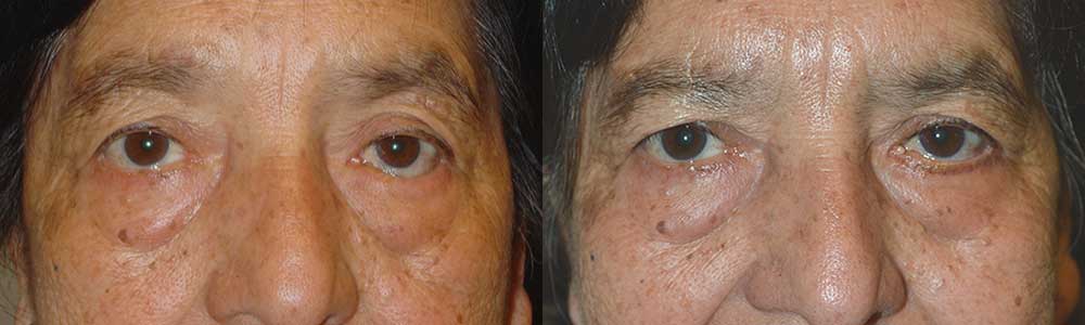 Los Angeles Eyelid Problem Surgery