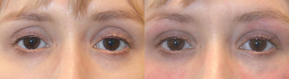 Beverly Hills Sunken Eyes Cosmetic Treatment