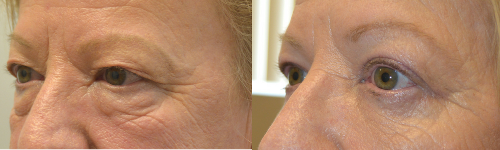 53 year old female, looking tired and older, underwent cosmetic Quad-blepharoplasty: upper blepharoplasty + lower blepharoplasty (transconjunctival with fat bags repositioning and skin pinch), under local anesthesia with oral sedation in the office. Before and 3 months after cosmetic eyelid surgery procedures photos are shown.