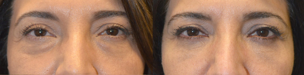 55 year old female, complained of under eye bags and dark circles. She underwent transconjunctival lower blepharoplasty with fat repositioning and skin pinch. Before and 2 months after cosmetic eyelid plastic surgery photos are shown.