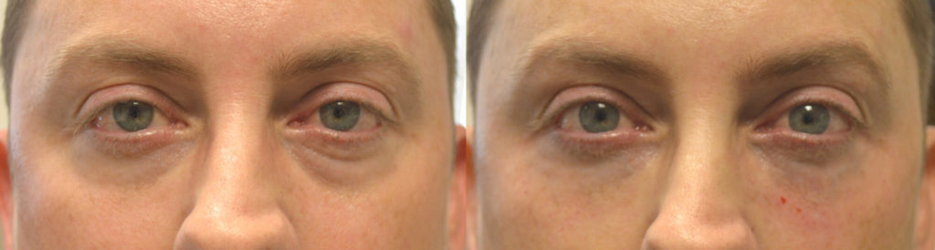 Baggy Eyes Injectables Beverly Hills