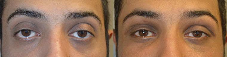 Los Angeles Canthoplasty Eyelid Procedure